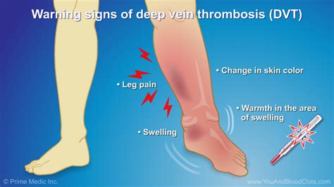 signs of dvt - Google Search | Nurse jokes, Nursing cheat sheet ...