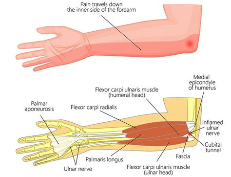 Ulnar Nerve Transposition