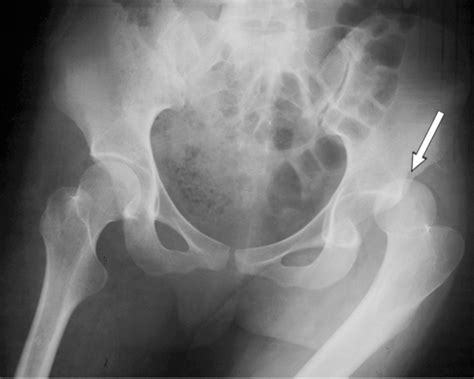 Anterior Vs Posterior Hip Dislocation