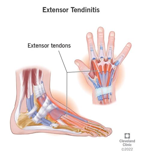 Extensor Tendonitis: What It Is, Causes & Treatment