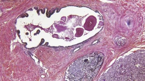 Adenocarcinoma: Types, Causes, Symptoms, and Treatment – Page 2 ...