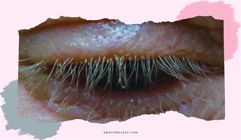 Demodex Blepharitis: Diagnosis, Risk Factors, And More!