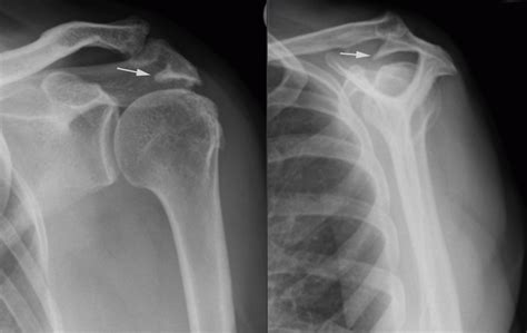 Subacromial Rotator Cuff Impingement