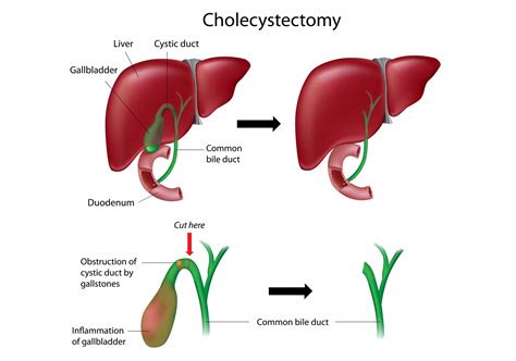 Gallbladder Surgery in Katy, TX | Dr. Clay Albrecht