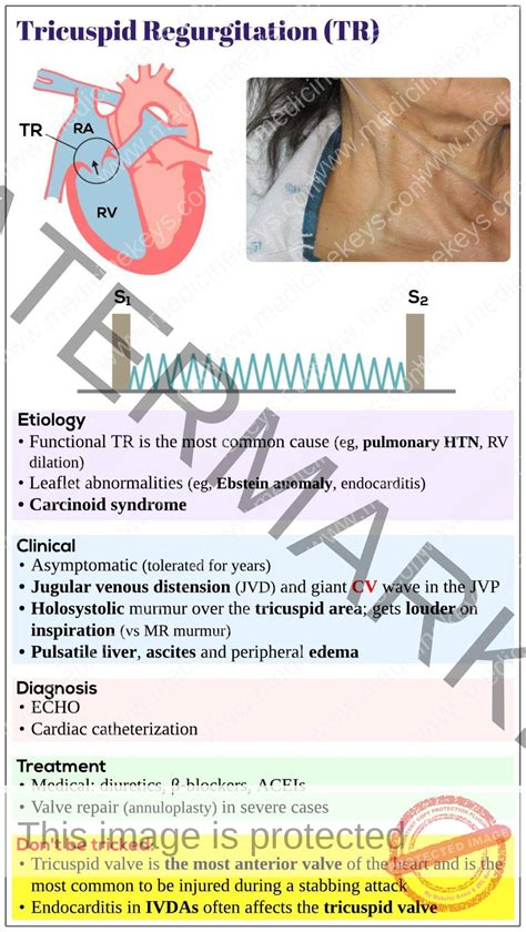 Tricuspid regurgitation (TR) - Medicine Keys for MRCPs