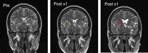 Recurrent non-functioning pituitary adenoma – Radiology Cases