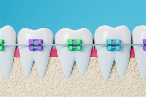 METAL BRACES help improve the defects of teeth. - vtrustdental.com