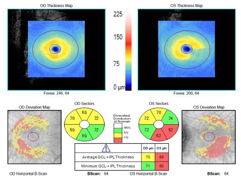 Breaking Down Visual Fields in Glaucoma