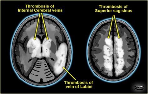 Cerebral Venous Thrombosis Radiology