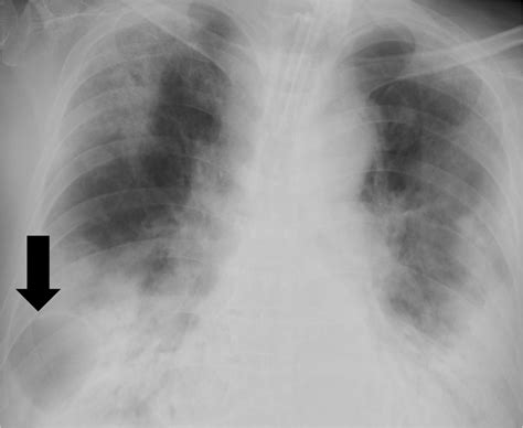 The chest X‐ray suggested a giant bulla in the right lung (arrow ...