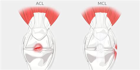 MCL Tear - The Complete Injury Guide - Vive Health