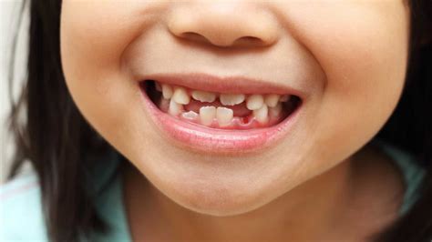 Cuidados com os dentes de leite: 3 dicas para mantê-los saudáveis – Sorrilagos – Clínicas ...