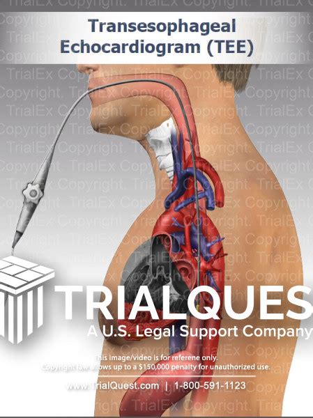 Transesophageal Echocardiogram (TEE) - TrialExhibits Inc.