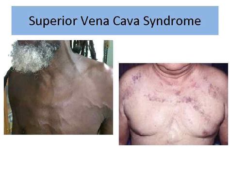 Superior Vena Cava Syndrome In Children