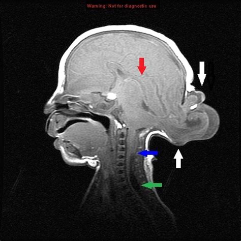 Occipital meningoencephalocele in a preterm neonate | BMJ Case Reports