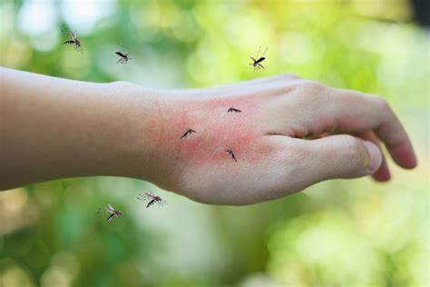 Mosquitoes,Bite,On,Adult,Hand,Made,Skin,Rash,And,Allergy - Pointe Pest Control | Chicago Pest ...