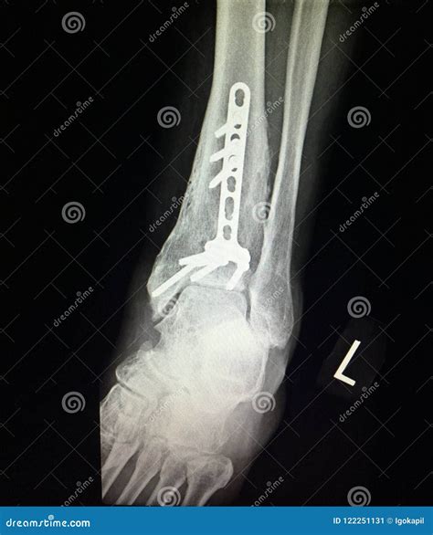 Ankle Left Tibia Distal Fracture Treatment Xray Stock Image | CartoonDealer.com #122251147