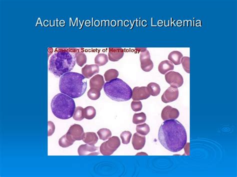 PPT - Leukemia PowerPoint Presentation, free download - ID:139315