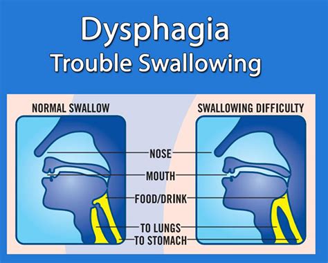 Dysphagia - Myositis Support and Understanding