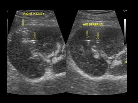 Perinephric abscess | Ultrasound, Radiology, Sonography