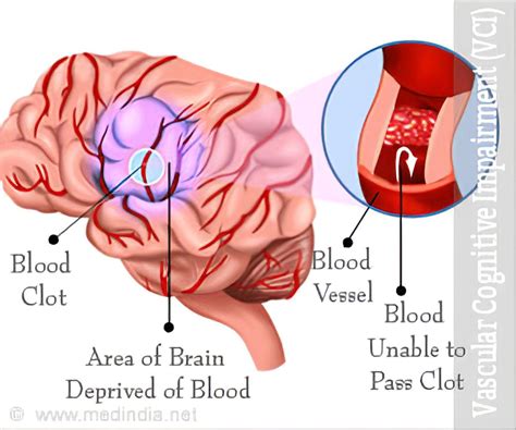 Vascular Dementia - Causes, Types, Symptoms, Diagnosis, Treatment, Prevention in 2021 | Vascular ...