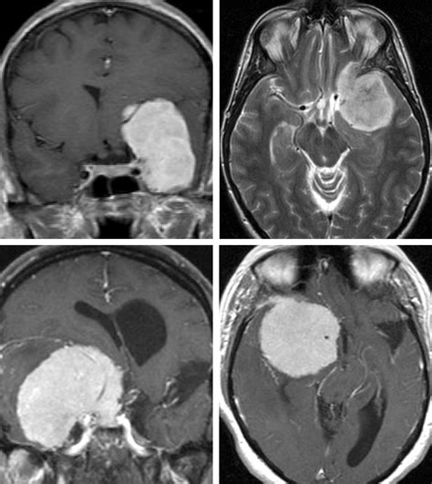 Sphenoid Wing Meningioma Mri