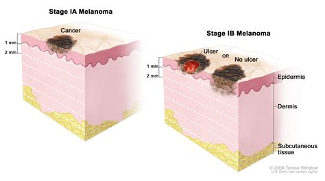 Melanoma Treatment (PDQ®) (Patients) - Siteman Cancer Center