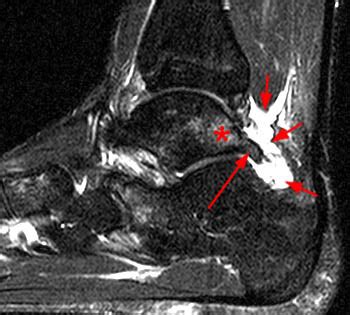 Posterior Ankle Impingement Syndrome Radiology Reference Article The | The Best Porn Website