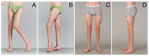 Medicina | Free Full-Text | Three-Dimensional Gait Analysis in Children Undergoing Gastrocsoleus ...