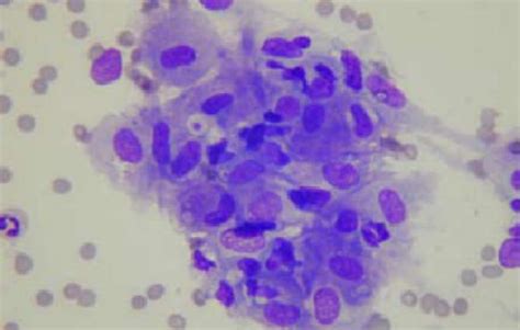 Granuloma-loose aggregates of epithelioid histiocytes | Open-i