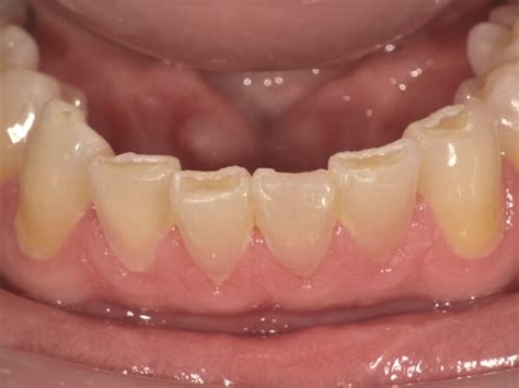 Show Your Work: Treating Incisal Edge Wear by Dr. Marvin Fier - Dentaltown