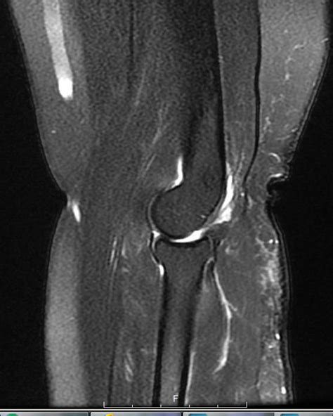 MRI LEFT ELBOW - Greater Waterbury Imaging Center