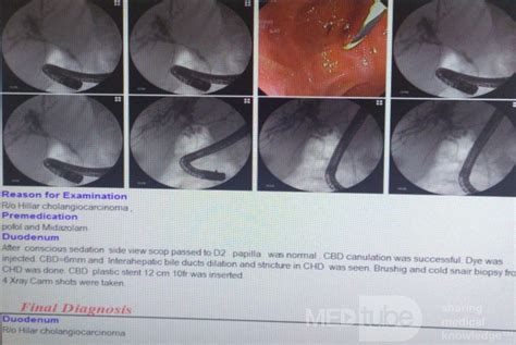 New Case for Direct Cold Forceps Biopsy From Proximal Part of CBD Cholangiocarcinoma Under ...