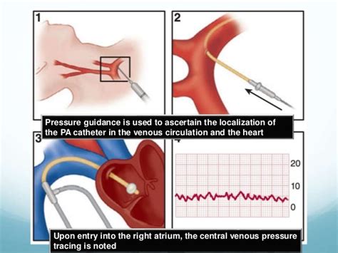 Pulmonary Artery Wedge Pressure