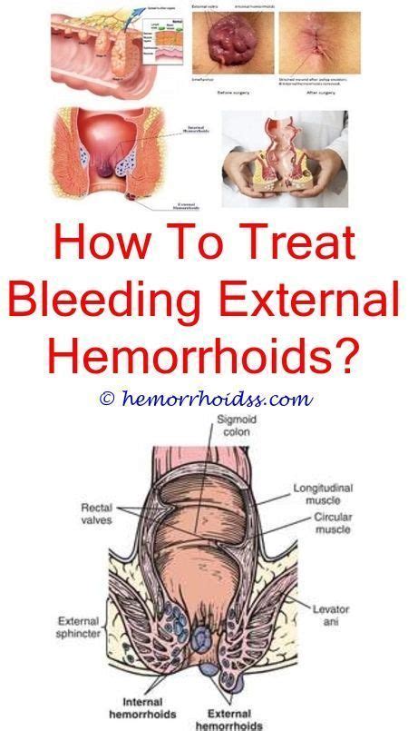 How to heal painful hemorrhoids?.Is preparation h good for bleeding hemorrhoids?.Can witc ...