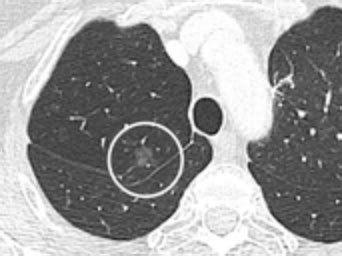 Pulmonary nodule differential diagnosis - wikidoc