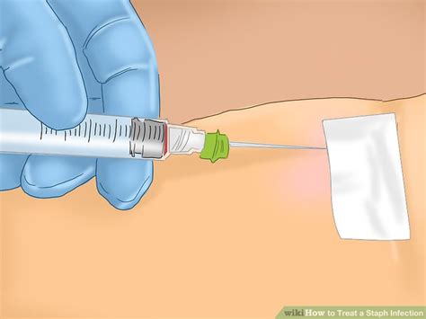 How to Treat a Staph Infection: 14 Steps (with Pictures) - wikiHow