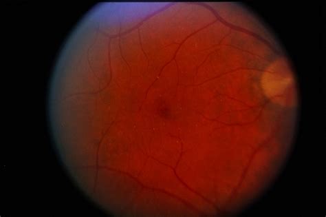 Talc Retinopathy - Retina Image Bank