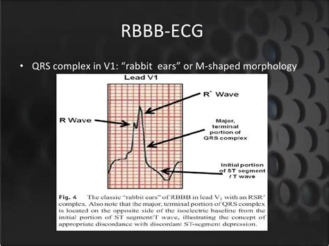 RBBB with STEMI