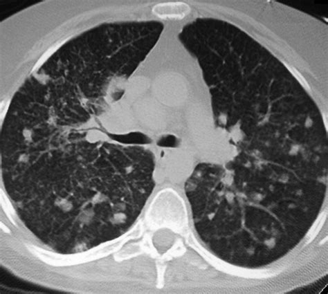 Imaging Manifestations of Blastomycosis: A Pulmonary Infection with Potential Dissemination ...