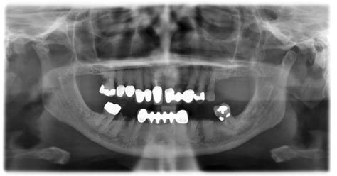 Mandibular Foramen Radiograph