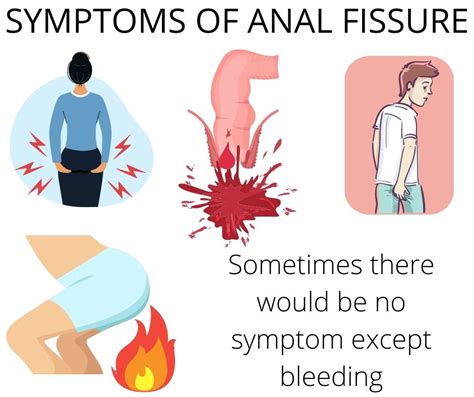 Anal fissure relief | The Top 7 Successful Solutions