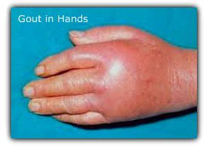 Gout in the Hands? Get Back To Work With Fast Relief!