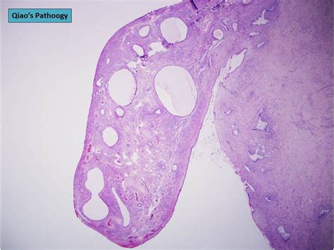 Qiao's Pathology: Mixed Endometrial-Endocervical type of C… | Flickr