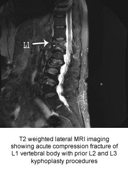 Compression Fracture | Michigan Medicine