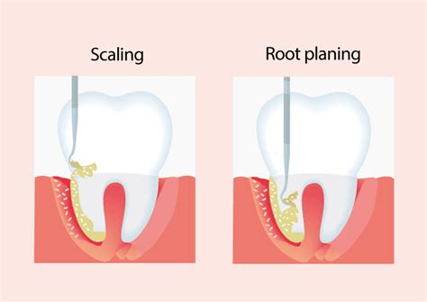 Copy of The-difference-between-scaling-and-root-planing-(deep-cleaning) - DP Dental