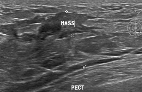 Male Gynecomastia Ultrasound