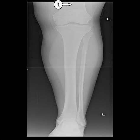 Mono Egoísmo multitud femur tibia fibula anatomy complejidad El propietario Tumor maligno