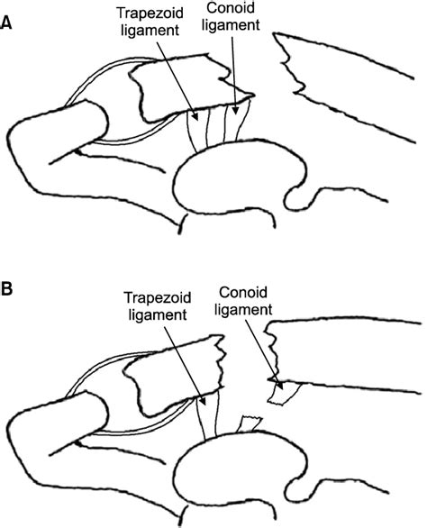 Distal Third Clavicle Fracture