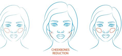 Cheekbone Reduction - Medical Help Turkey